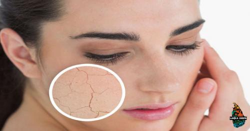 Natural Remedies You Can Use to Avoid Dry Skin